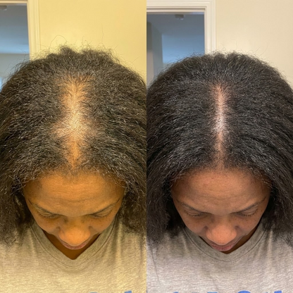 Flxbryte Hair Restoration Roller